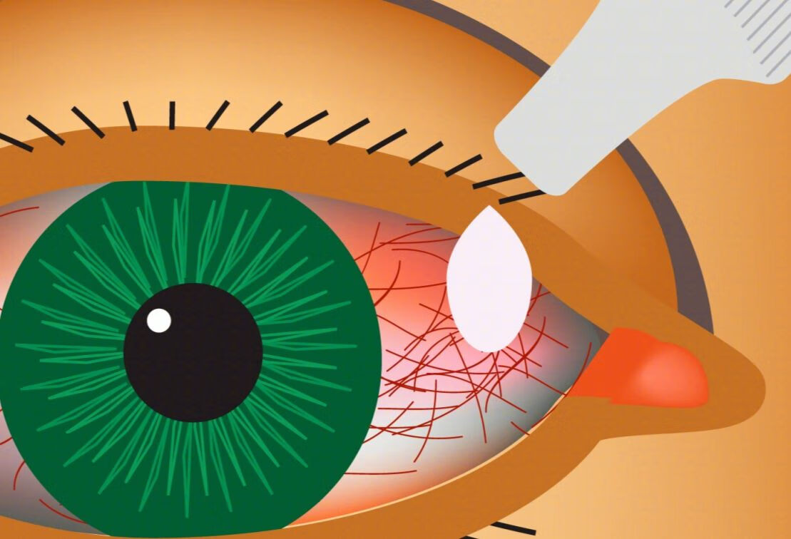 过敏性结膜炎用中药敷眼睛有用吗？