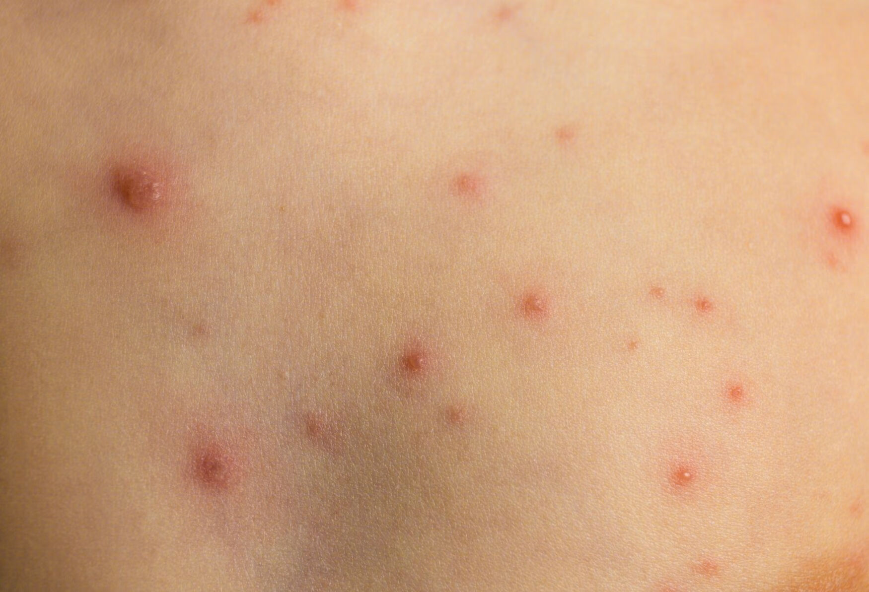 应该如何区分湿疹和冻疮呢？