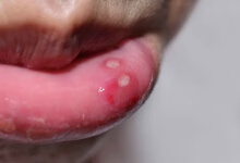 过敏性唇炎能自愈吗 介绍治过敏性唇炎的关键要点