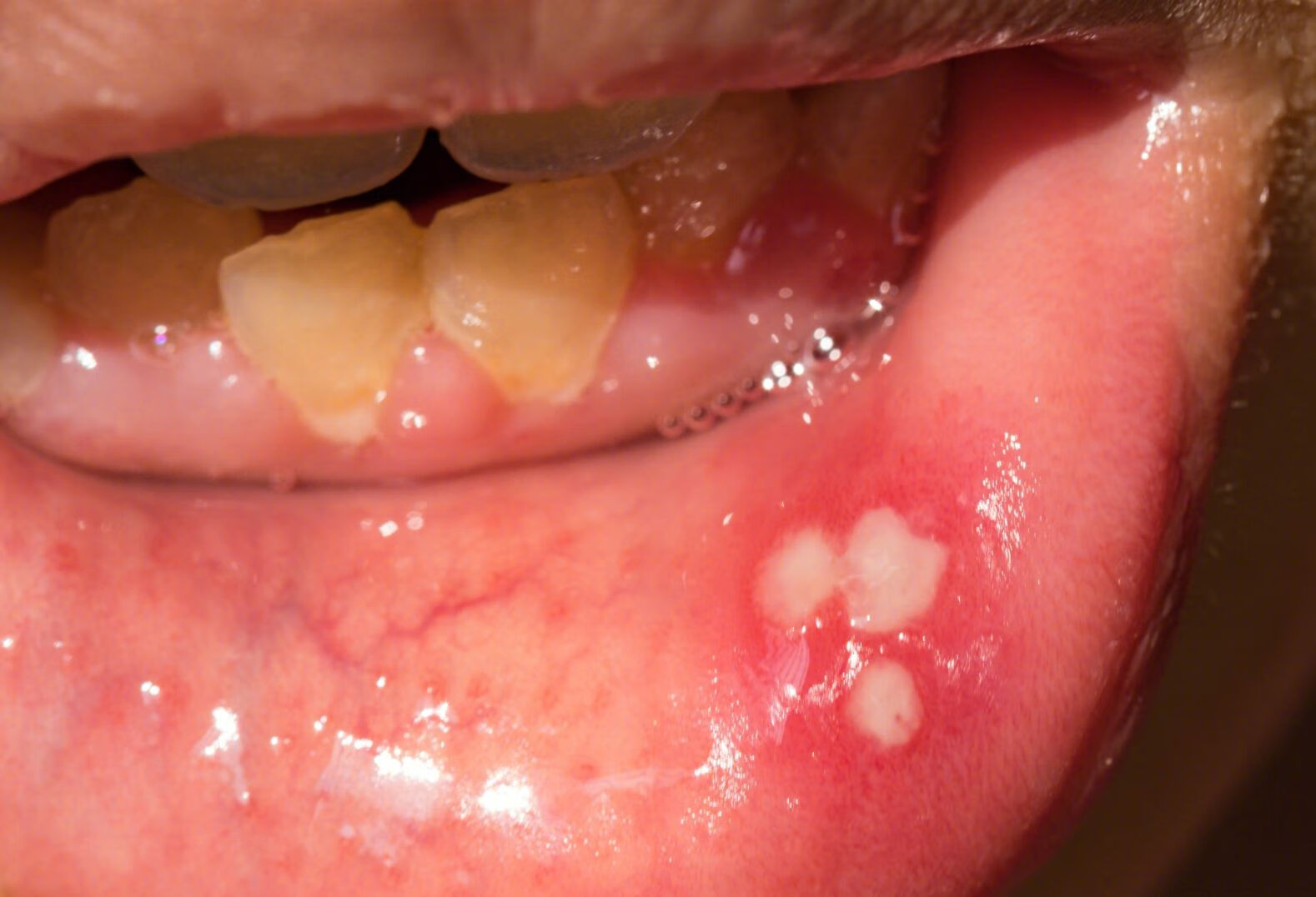 造成口腔经常溃疡原因有哪些？