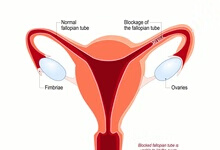 女性输卵管堵塞能治好吗