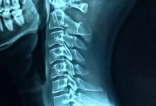 治疗腰椎间盘突出的五种方法