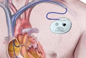 脑梗塞高血压心跳过缓能安装心脏起搏器吗？