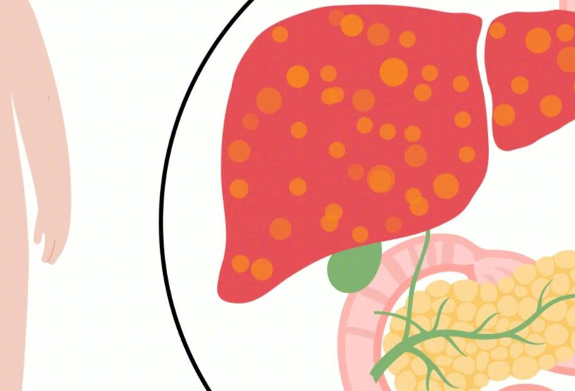 得了脂肪肝营养怎么调理？