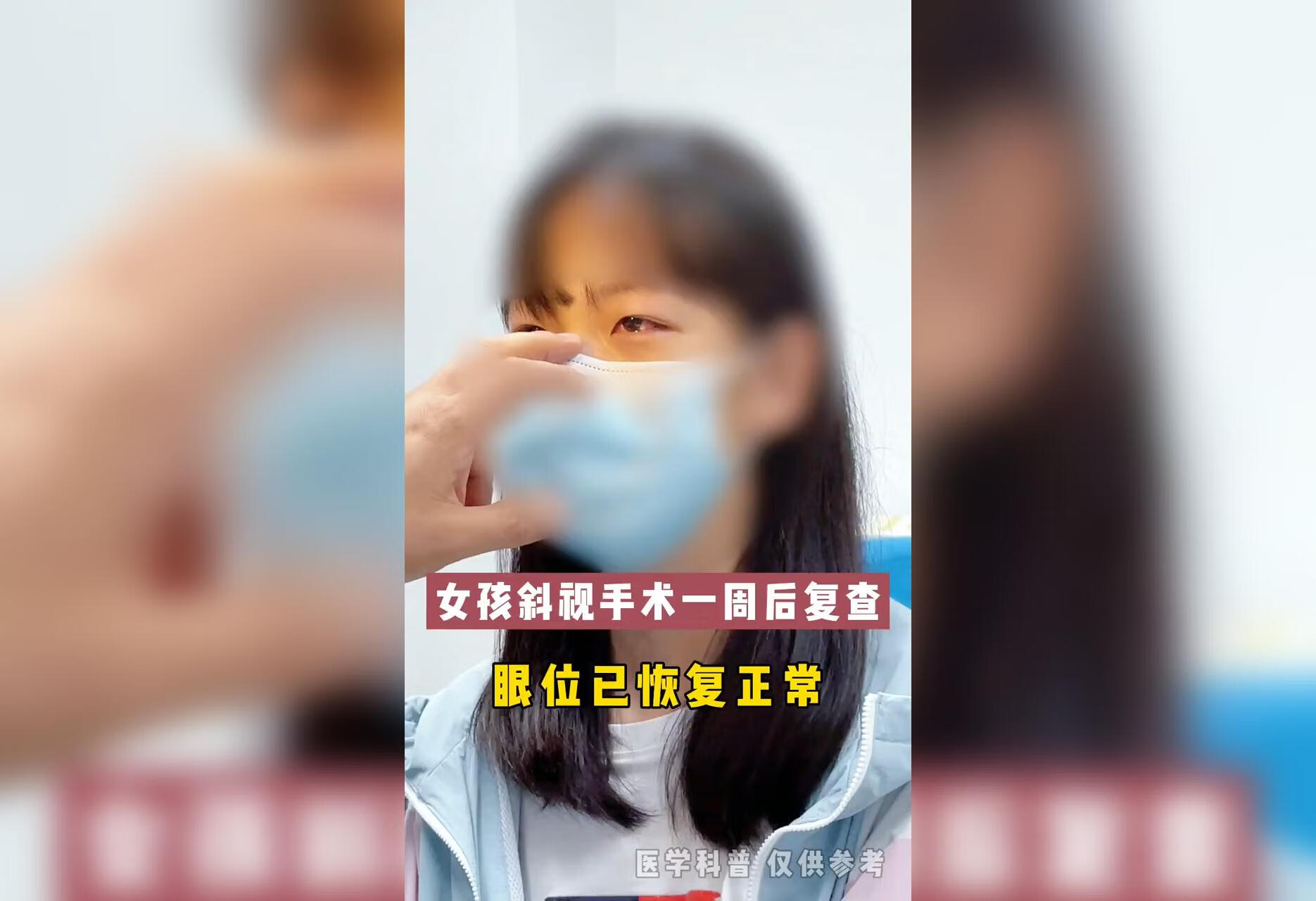 斜视手术 术后一周复查