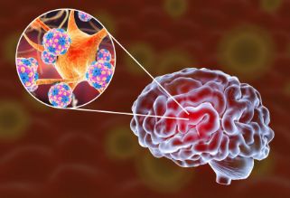 老年结核脑膜炎，该如何预防和治疗？