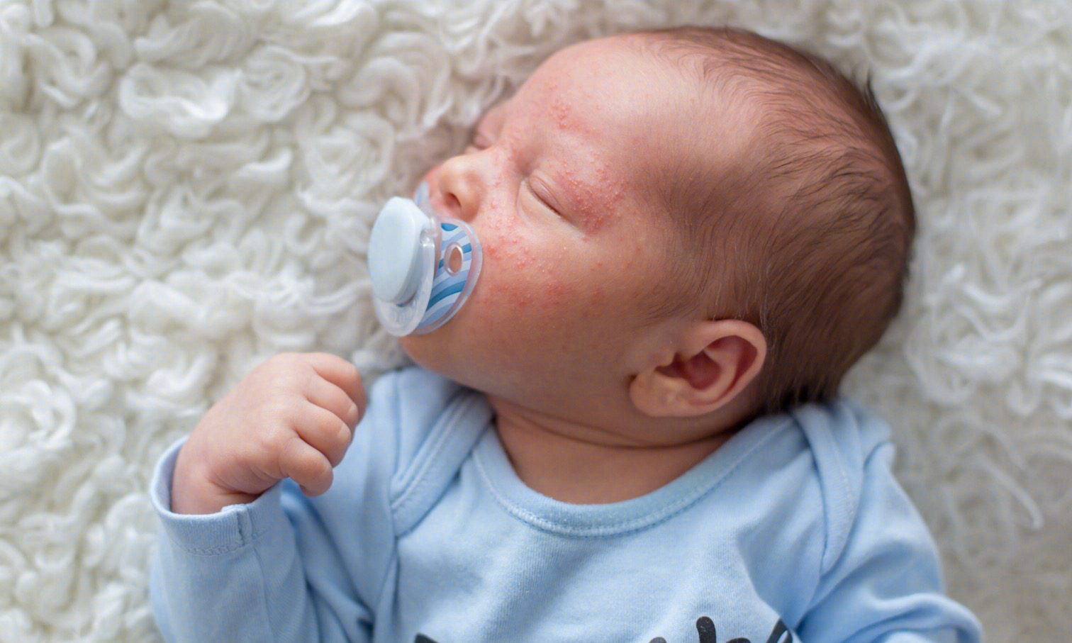 湿疹宝宝越来越多，这几个预防方法要记牢