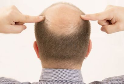 秃头的预防办法有哪些?