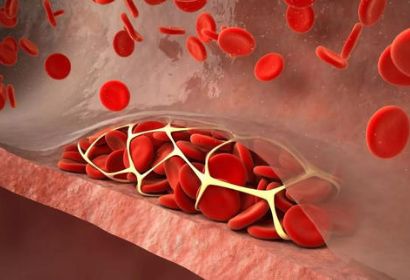 血栓喜欢堵全身动脉硬化的信号有哪些？