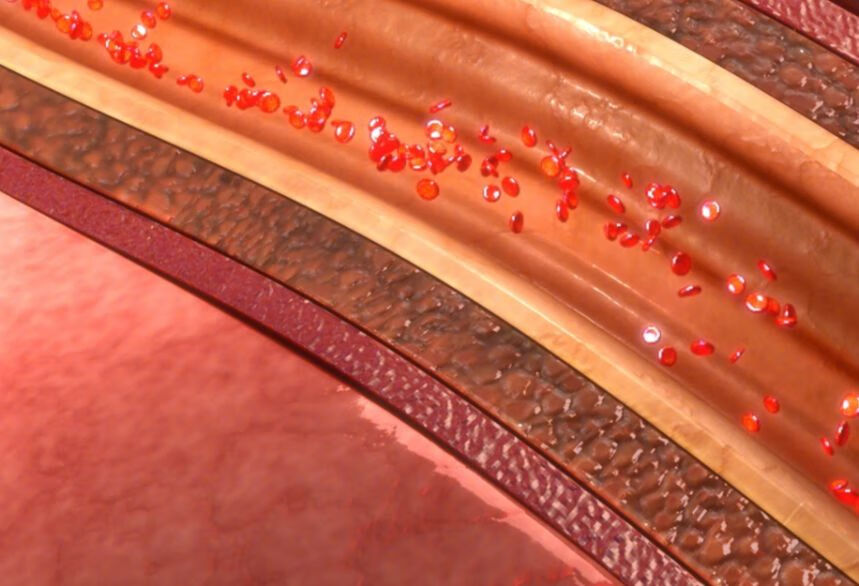 软化血管的4大误区您知道几个？