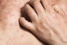 皮肤过敏怎么止痒擦什么药     几种外用药物治疗皮肤过敏