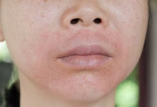 脸上皮肤湿疹怎么办  三个方法可根治湿疹
