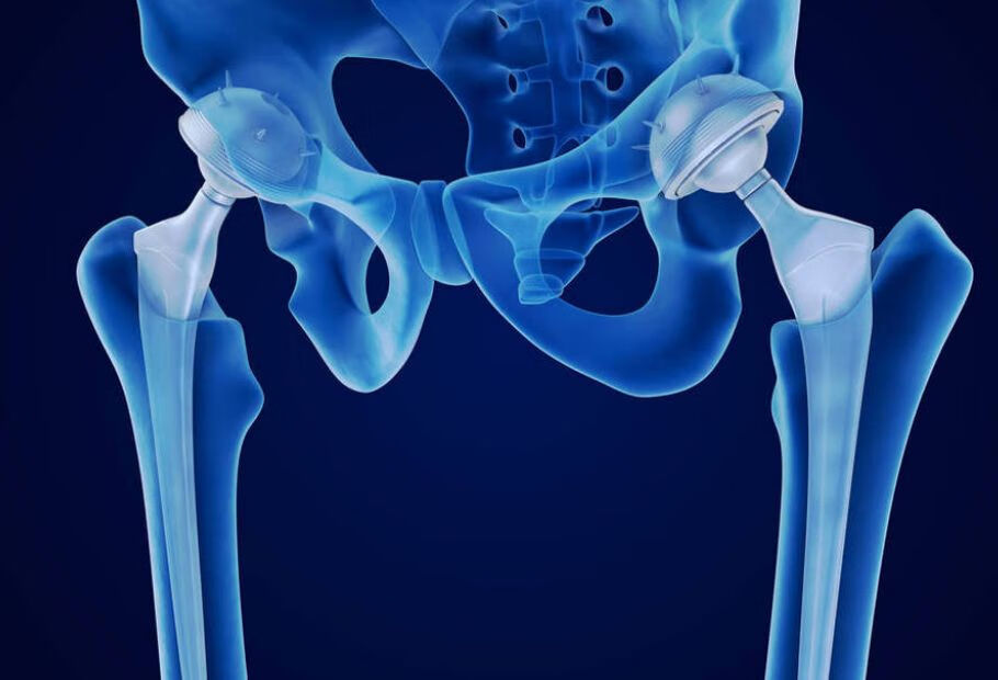 股骨头坏死如何进行预防？