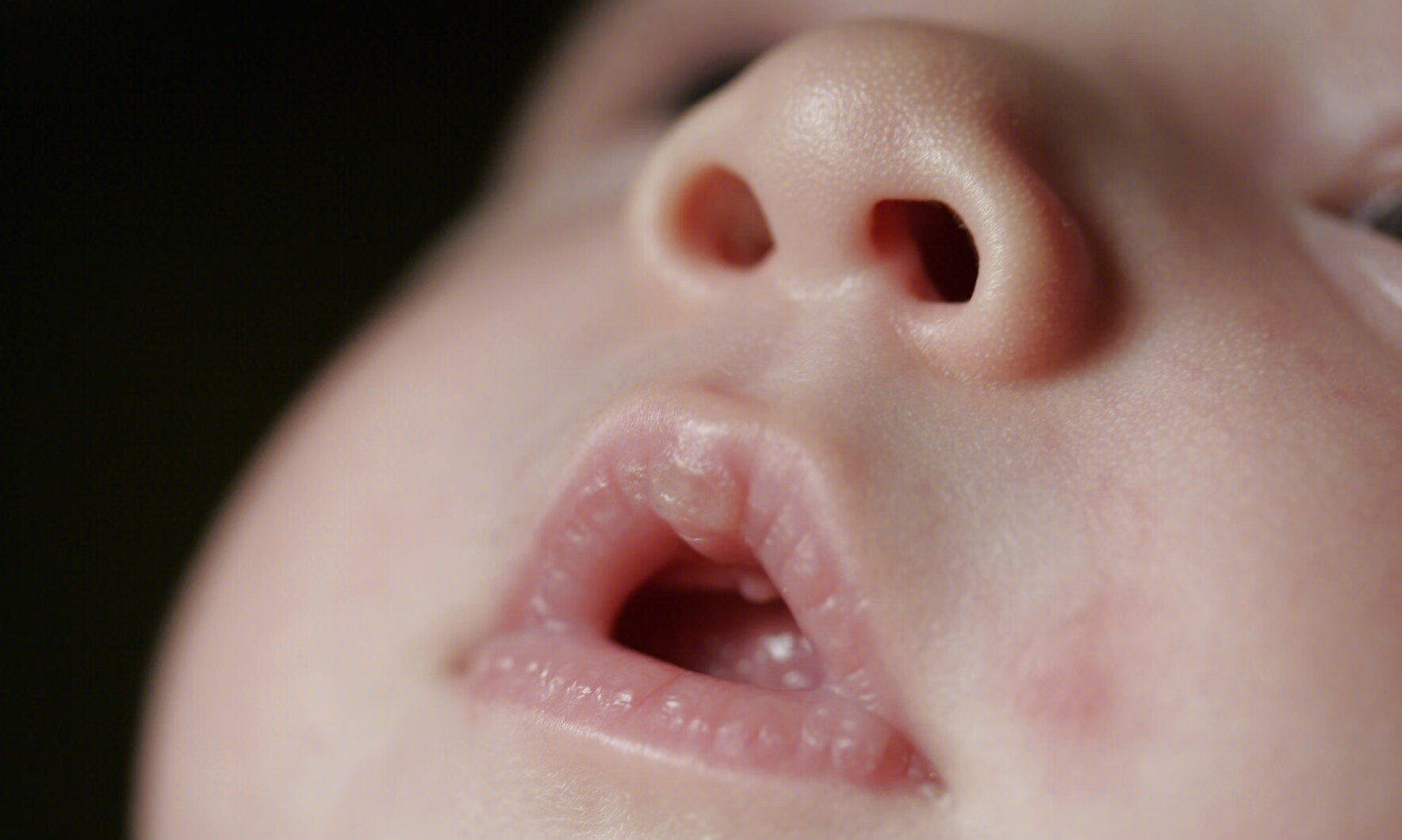 孩子张口呼吸不仅会变丑，还可影响身高和智力发育！