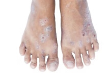 手足皲裂是什么样的 认识手足皲裂的症状表现