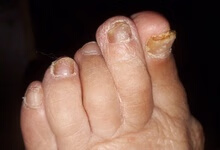 真菌侵入或致灰指甲 治疗避免3个大误区