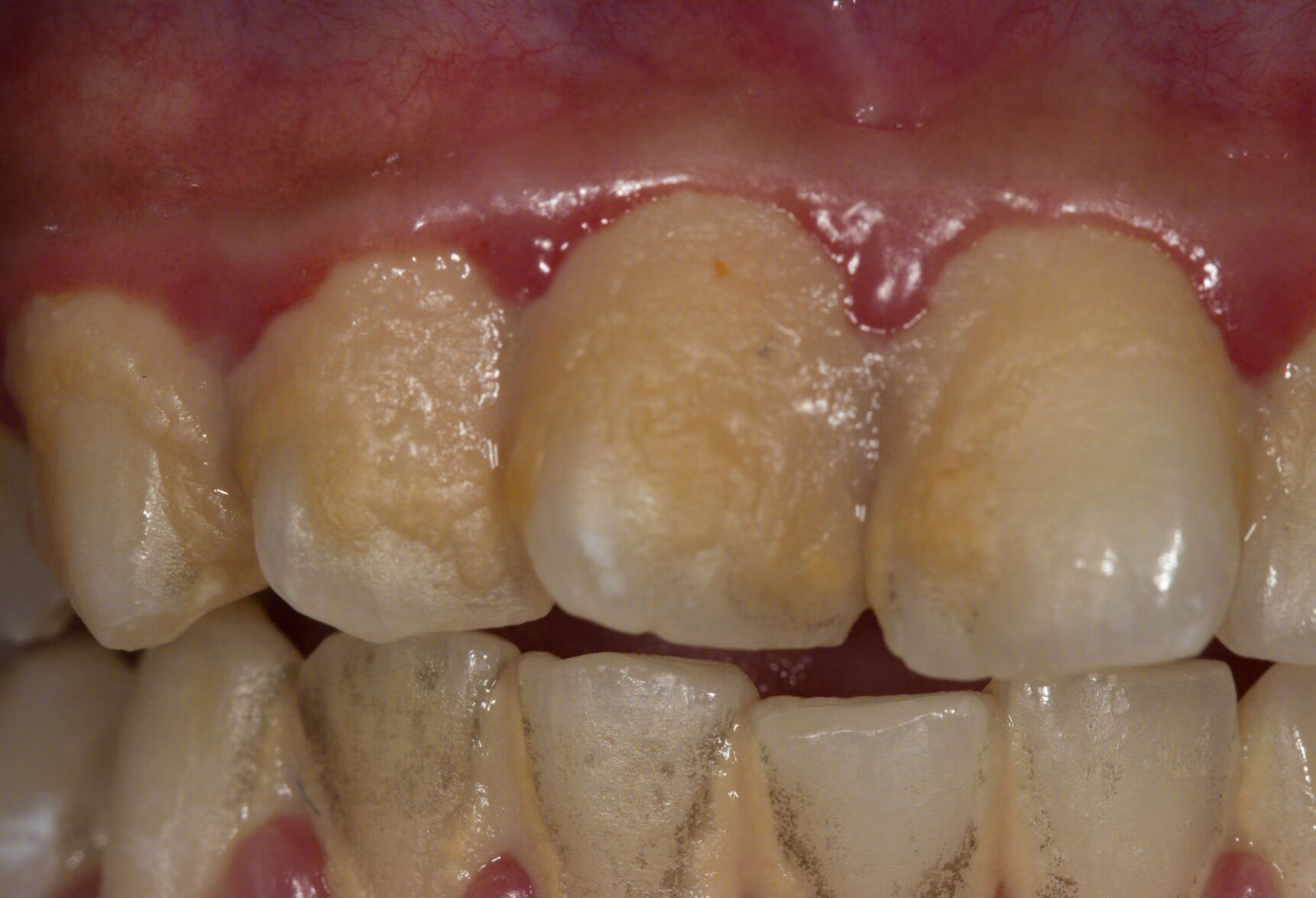 牙结石的主要症状有哪些？为什么会发生牙结石呢？