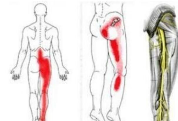 右肋痛、背疼、腿疼是怎么回事？