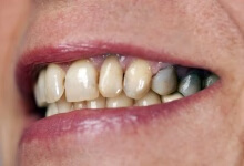 吃什么能预防牙龈萎缩