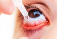 过敏性结膜炎用哪些眼药水