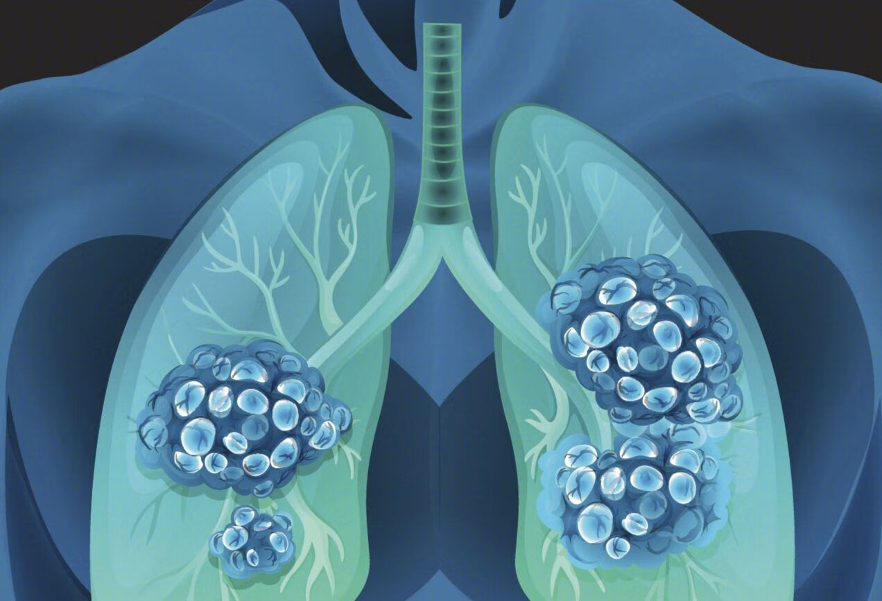 肺结节恶化都有哪些表现？
