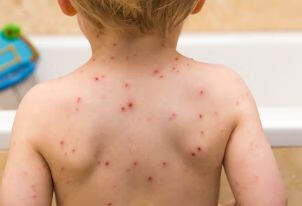 水痘只限于孩子吗？成年人也可能感染或复发