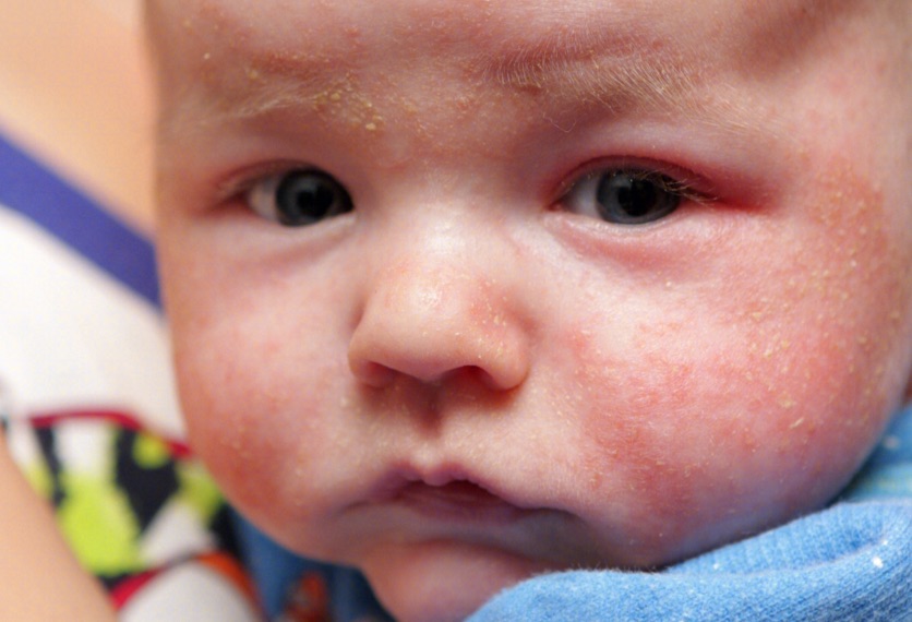 婴幼儿牛奶蛋白过敏，各位宝妈知多少？