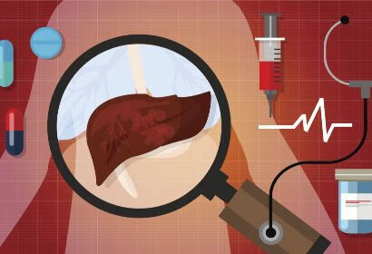 脂肪肝的祸根找到了，有5大病因，一文为您解析
