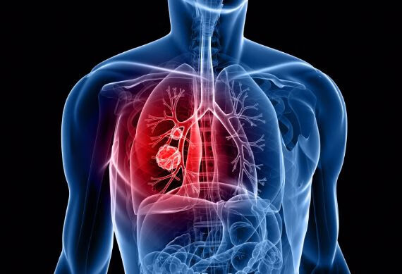 家里有人得肺癌，其他人患肺癌可能性大吗？