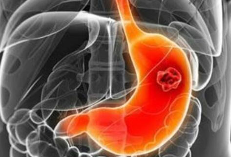 胃癌如何早期发现？抽血筛查胃癌靠谱吗？