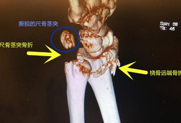 吴京暗示老婆桡骨远端骨折，他最想知道的5个骨折问题