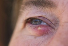眼睑发炎可以自愈吗 多个方法改善眼睑发炎
