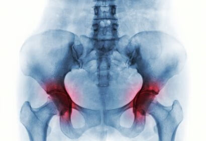 慢性腰肌劳损怎么办？总结7种方法，解决腰疼问题