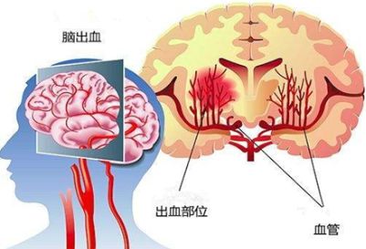 高血压患者预防脑出血，除了烟酒，避免这5个直接诱因