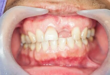 口腔种植牙的优点有哪些  种植牙6个优点让你不再犹豫