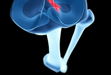 膝关节半月板损伤用氨糖好用吗 膝关节半月板损伤用这些药可改善