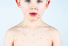 小儿风团荨麻疹如何治疗呢