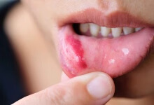 舌头起血泡怎么办 舌头起血泡的几个改善方法分享