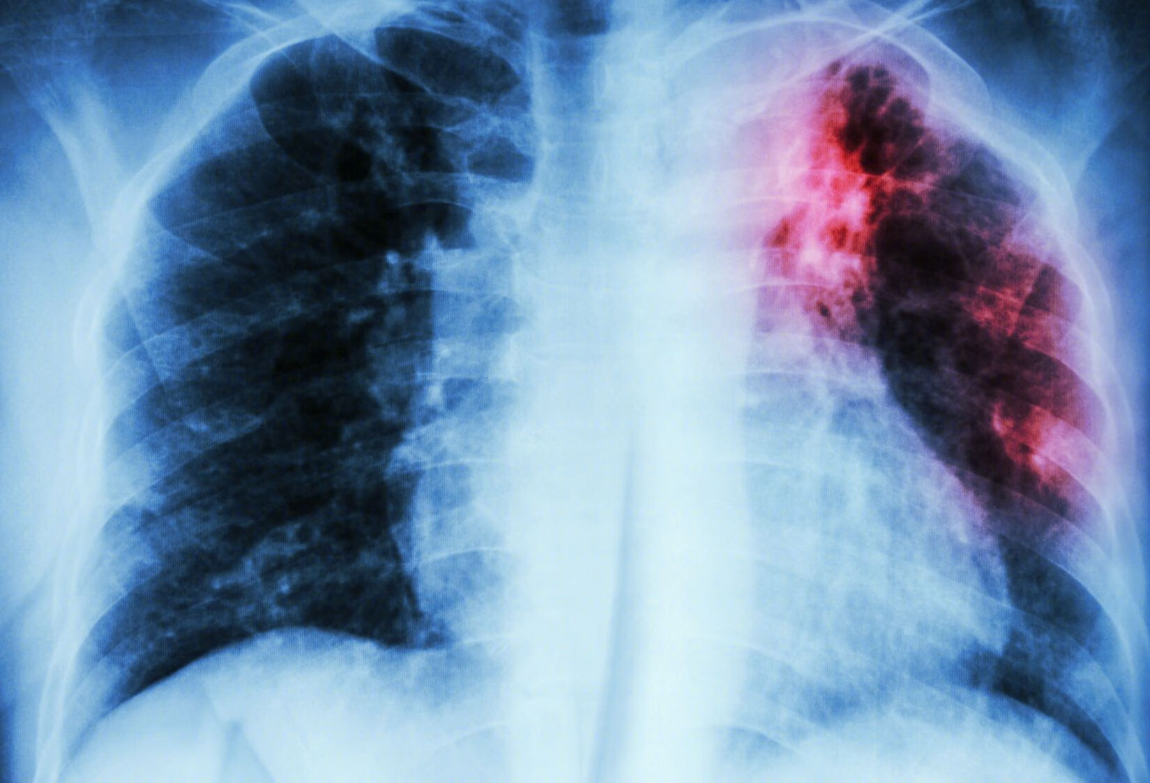 为什么患上肺纤维化会出现身体消瘦的情况？