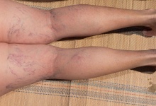 小腿肌间静脉血栓严重吗 小腿肌间静脉血栓的严重症状介绍