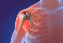 骨质增生会引起肩周炎？
