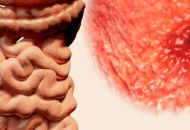 预防大肠癌学会自检肠道？