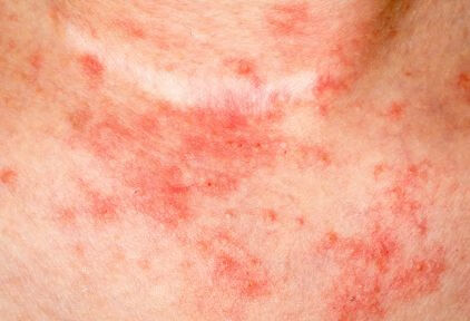引起湿疹的原因到底是什么？