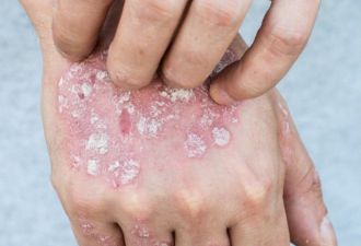 你一定要知道的冬季常见的4种皮肤病用药