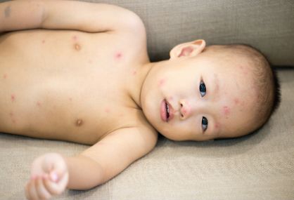 宝宝湿疹和尿布疹有什么区别？