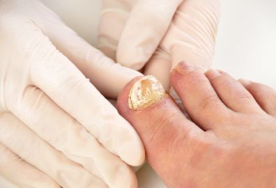 如何预防灰指甲？治疗灰指甲有哪些误区？