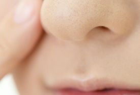 鼻涕带血丝是鼻咽癌吗？认识鼻咽癌的3大症状