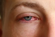 关于红眼病的护理方法！