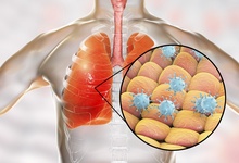 气管炎的发病机制是什么？