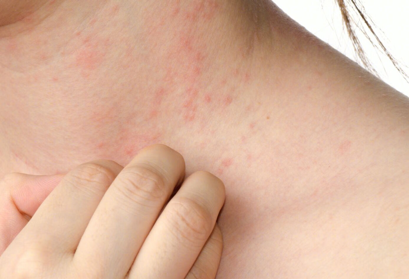 黄疸皮肤瘙痒治疗方法？